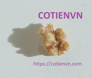 Điều trị chống sỏi thận tại nhà